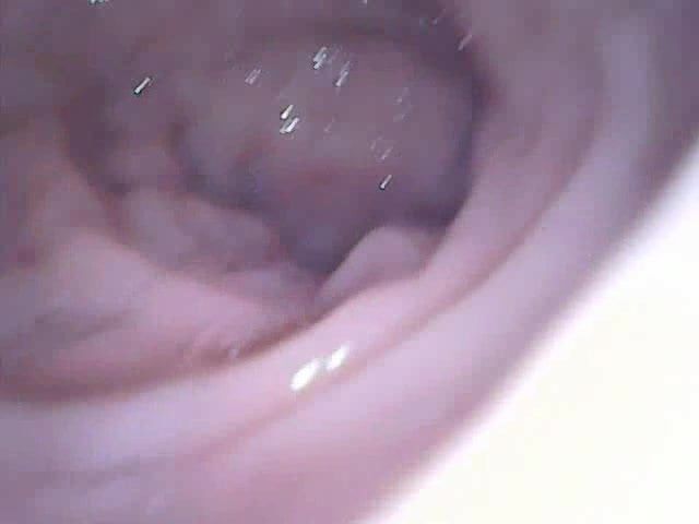best of Endoscope anal