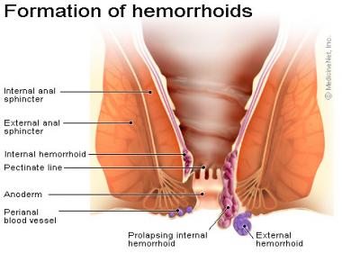 Difference between anal abcess and hemorroids