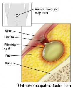 Fistula in anus
