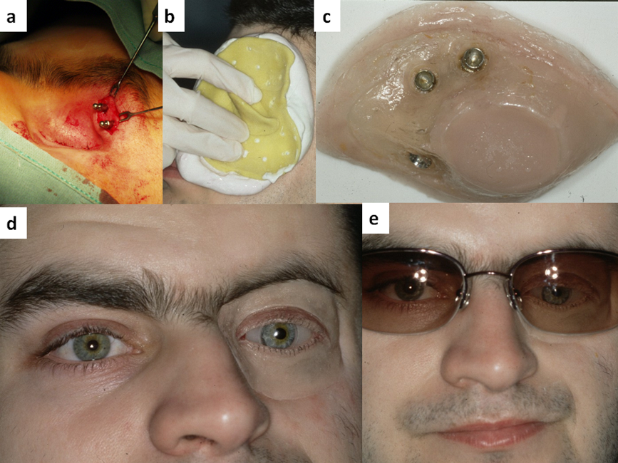 best of Prostheses Extensive facial