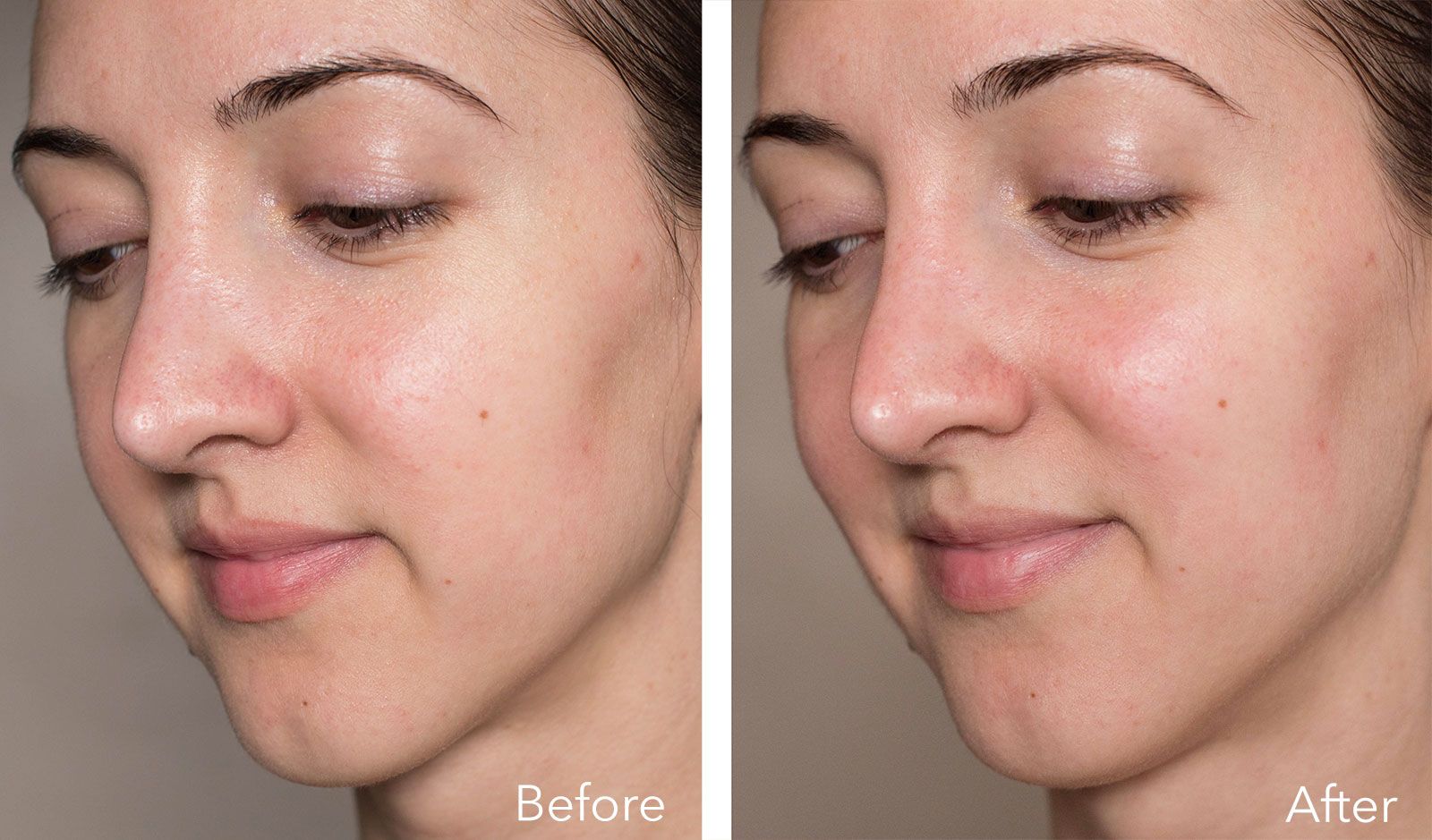 Facial before and after photos