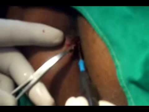 Skyscraper reccomend Surgery for anal skin tags