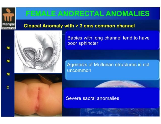 Ectopic anal canal