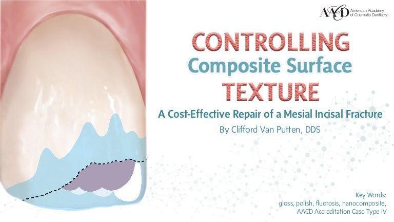 Glitter reccomend Mesial incisal and lingual facial composite