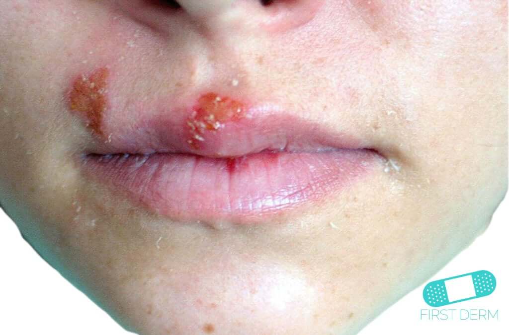 best of Treatment Facial herpes