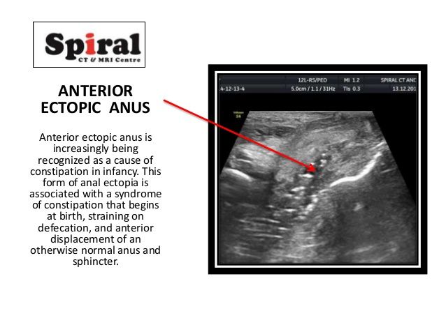 best of Anal canal Ectopic