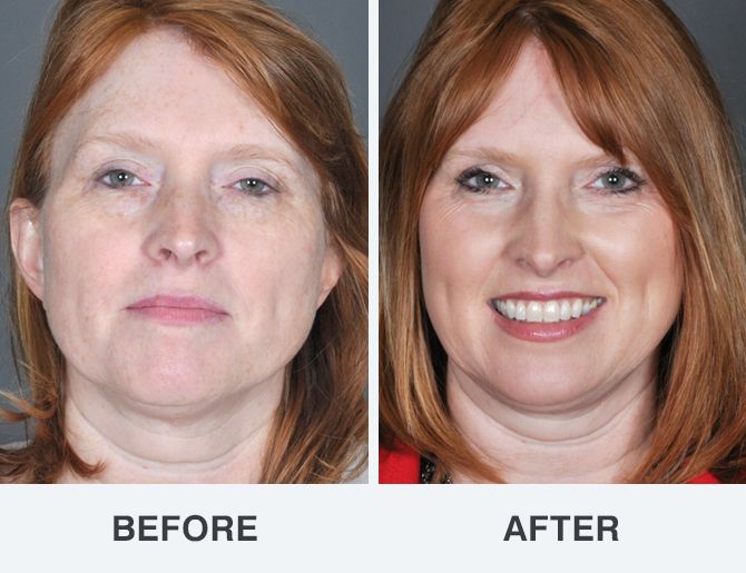 best of Before photos after Facial and