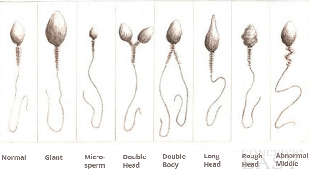 best of Sperm Abnormalities in