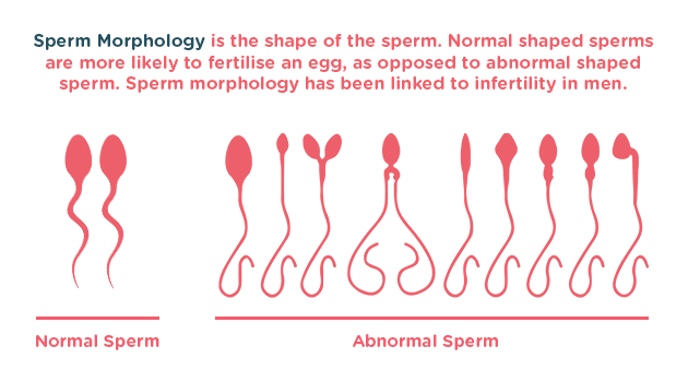 Abnormalities in sperm