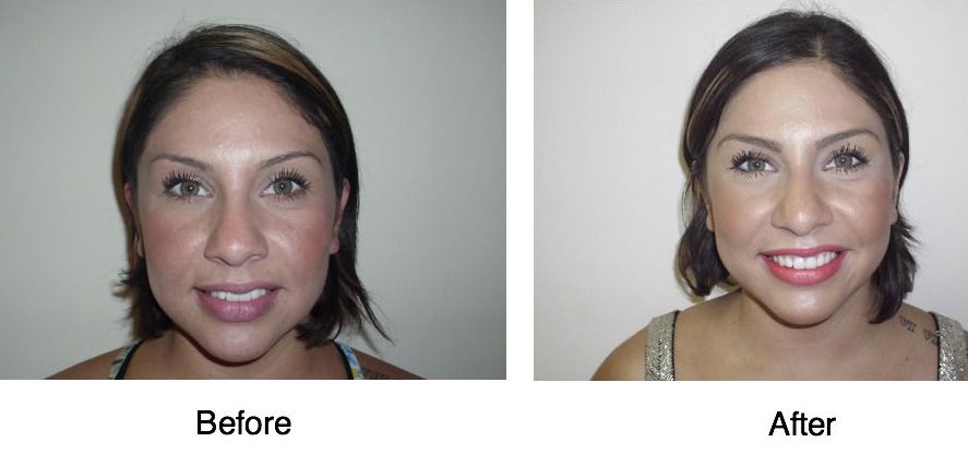 Sugar reccomend Acupuncture after before by facial rejuvenation