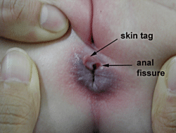 Frontflip reccomend Surgery for anal skin tags