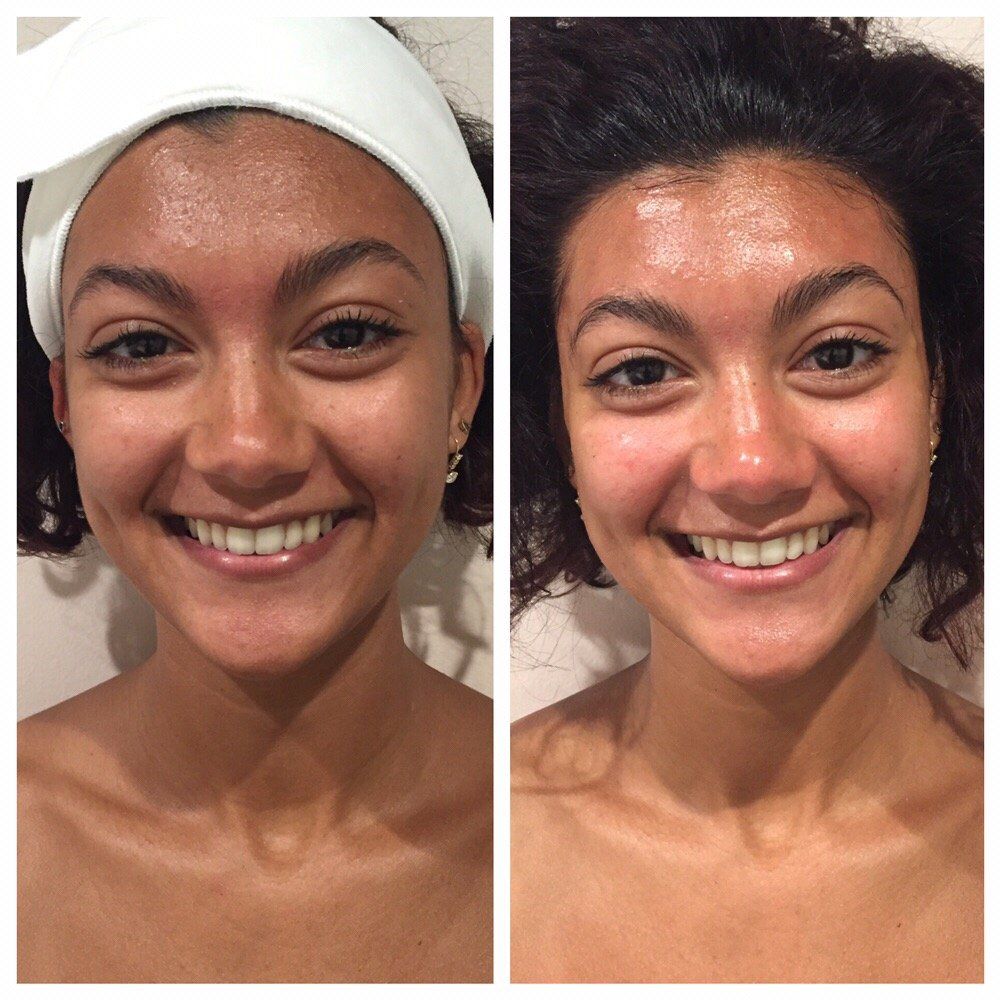 Sneak reccomend Facial before and after photos