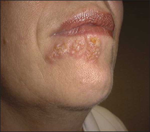Facial herpes treatment