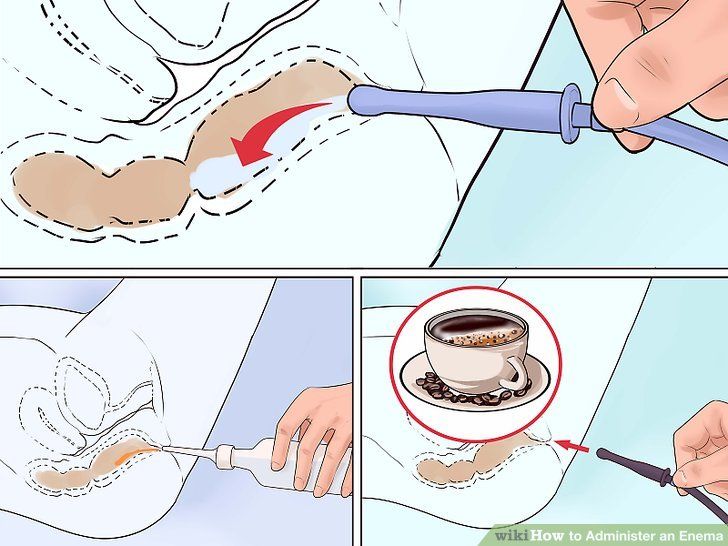 Inserting an enema in the anus