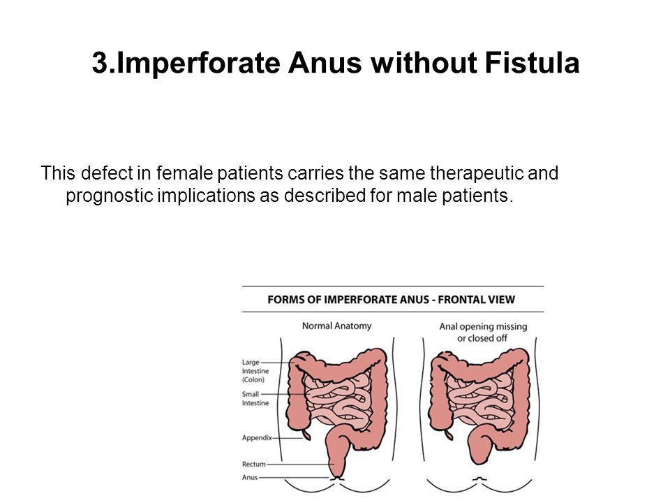 Newborn assessment imperforate anus