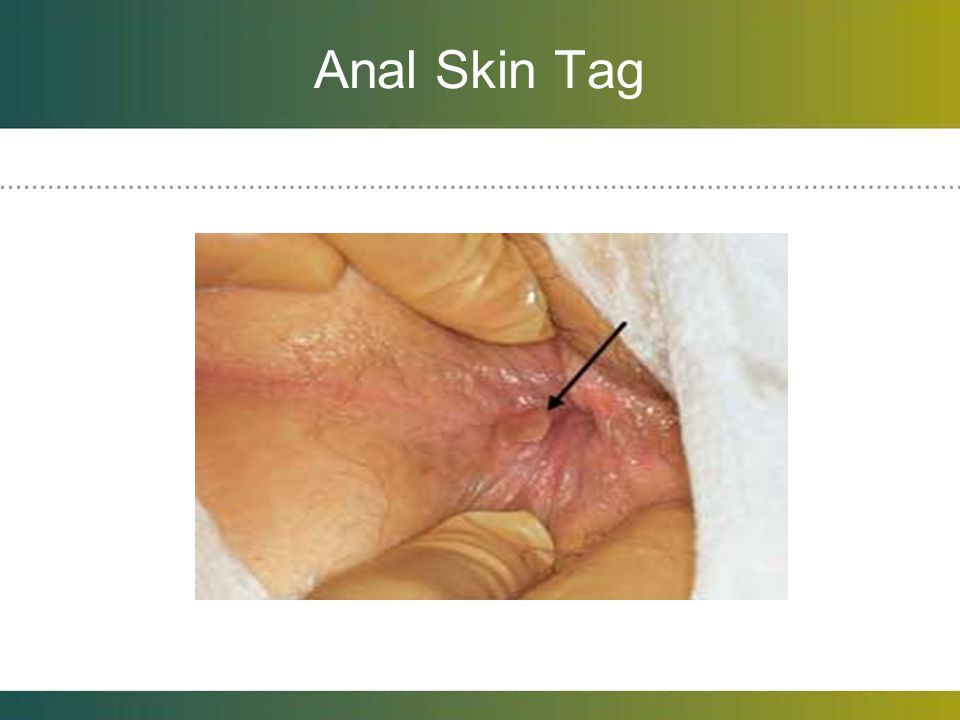 Surgery for anal skin tags